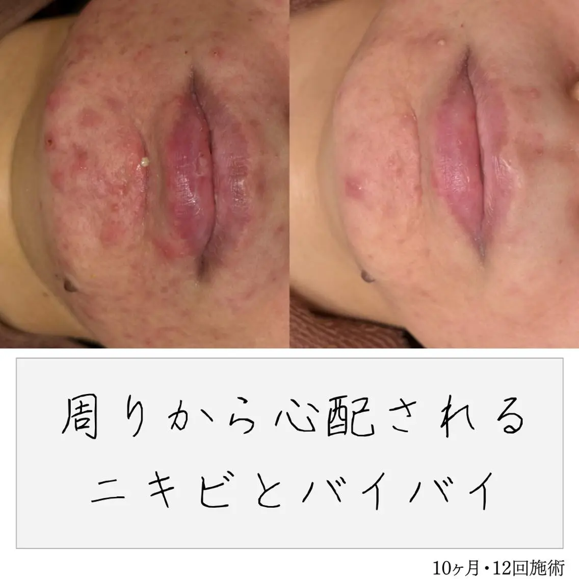 ニキビ経験者が施術 する専門サロン🌻のエステ・リラクイメージ