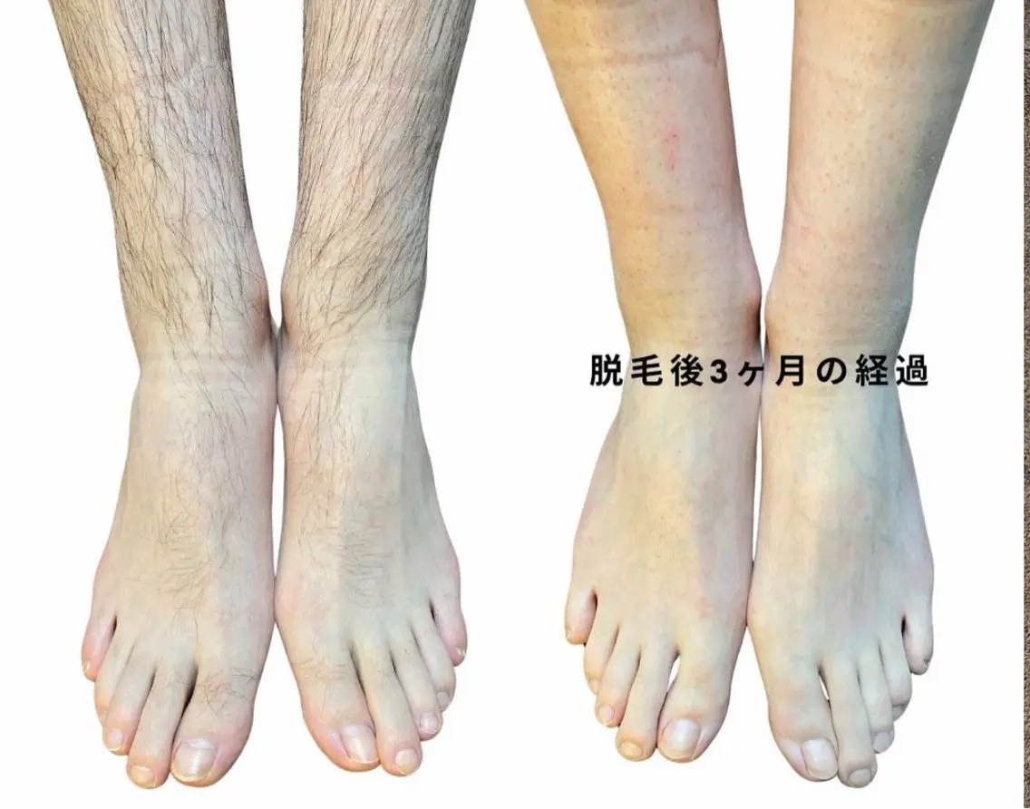 手の甲、足の甲脱毛の写真
