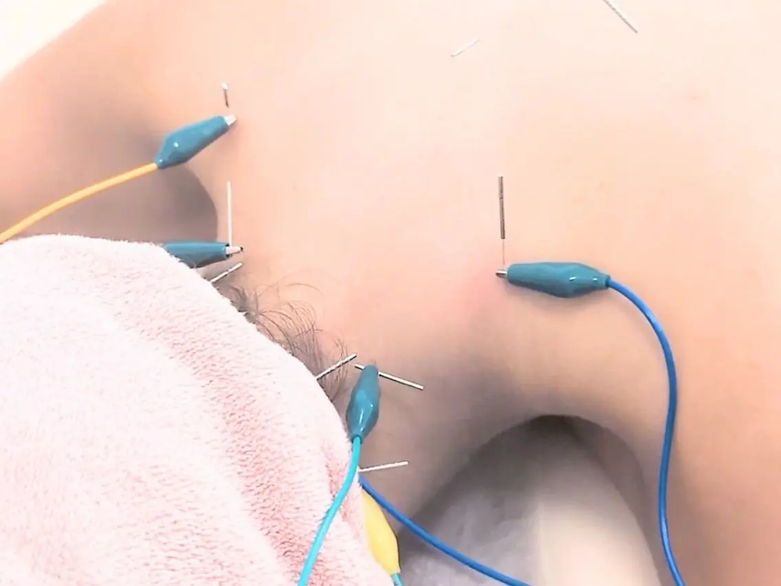 【 口コミ割 】 電気美容鍼+全身鍼灸 +お悩みに合わせた整体 全身の疲れをとりたい方 (首肩こり 自律神経調整)の写真
