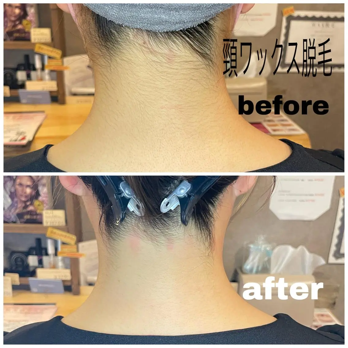 ⭐︎初回⭐︎頸(うなじ)3000円 Wax脱毛(ハードWax使用)の写真