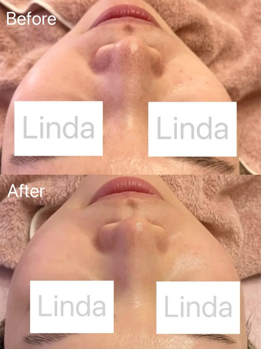 エステ 小顔&毛穴・肌質改善 LINDA西宮 AIのエステ・リラクイメージ