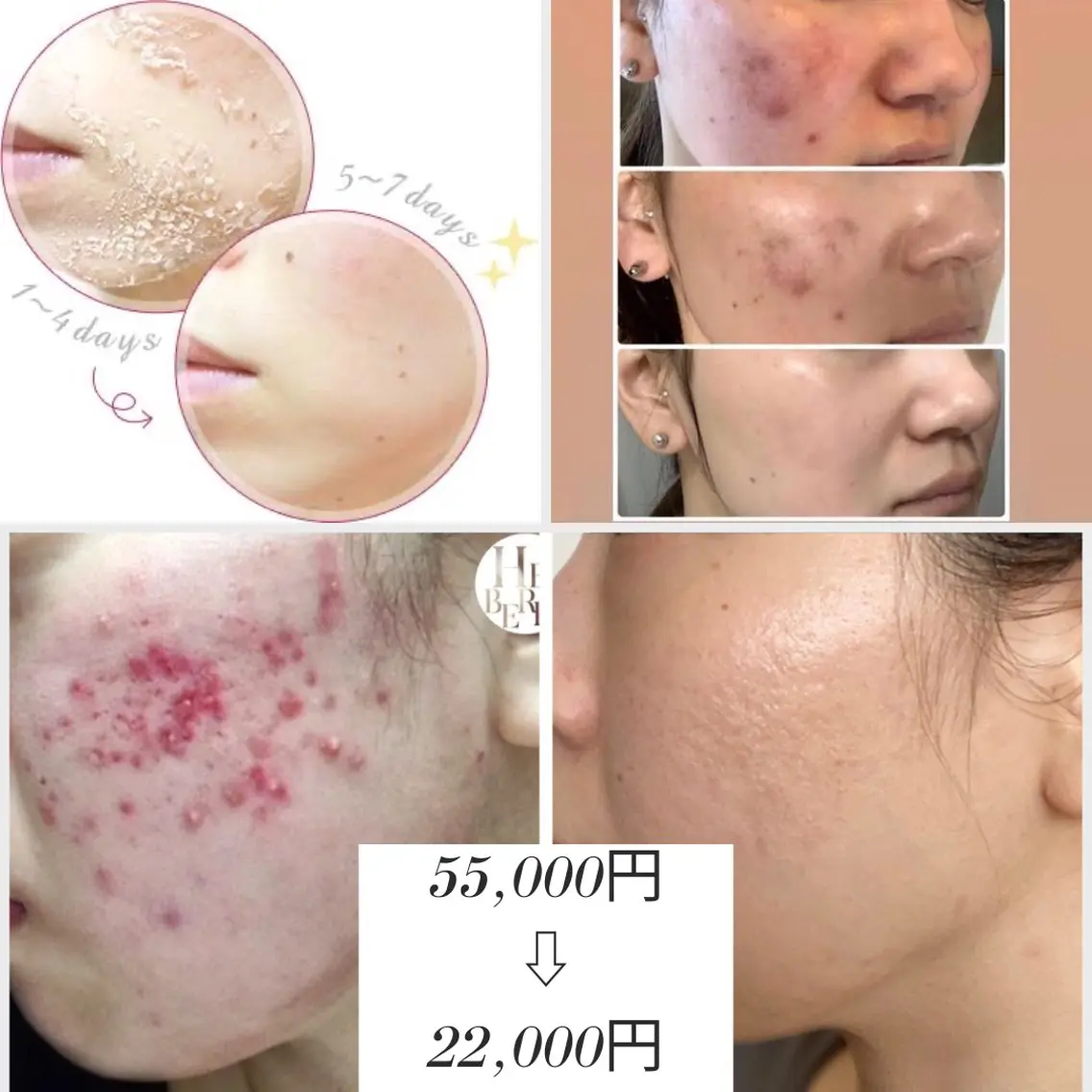人気No.1🧡ハーブ界1の肌結果FCR/リベル剥離ありハーブピーリング🌿クレーター、ニキビ跡はこちらのコースを！の写真