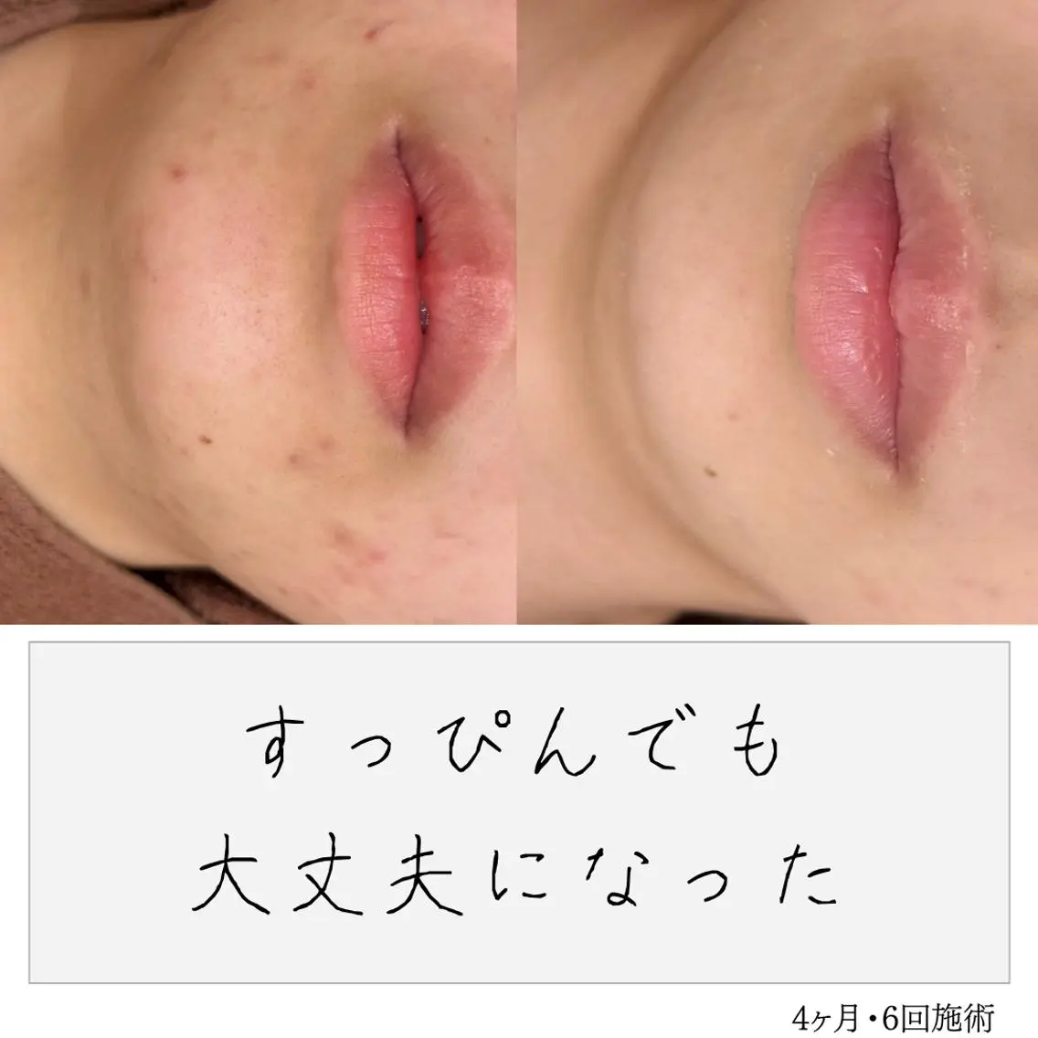 ニキビ経験者が施術 する専門サロン🌻のエステ・リラクイメージ