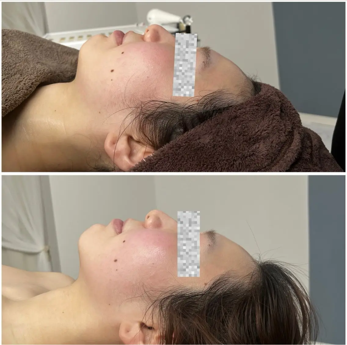 【あっという間に小顔へ💆🏻‍♀️】 お顔の筋膜リリースと骨格調整でシュッとしたフェイスラインGET✨施術時間60分の写真