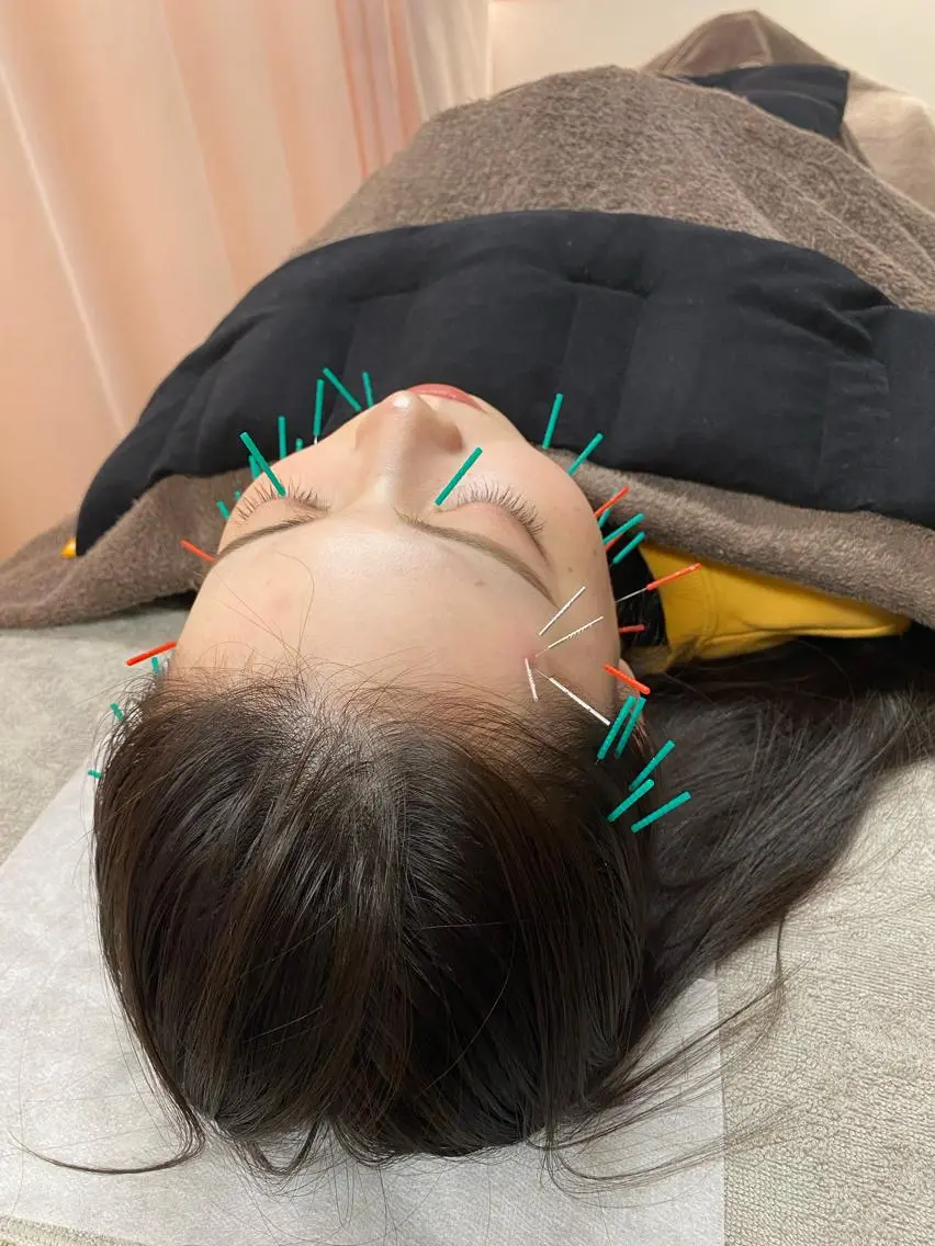 二回目以降美容鍼✨💆🏻‍♀️ 【口コミ割引適応】の写真