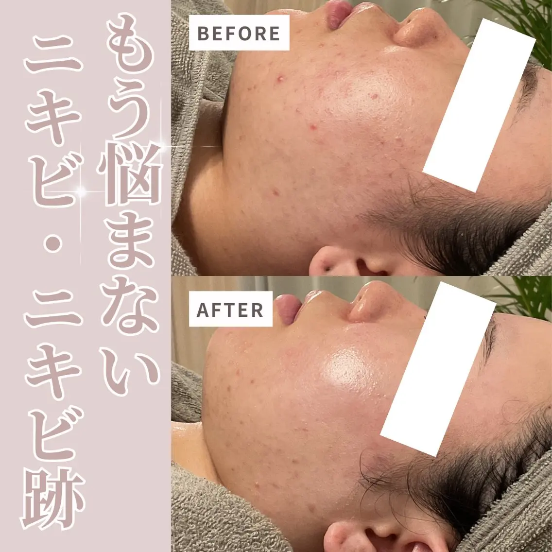 エステ 美肌サロン💎ハーブ ピーリング🌿ルプレのエステ・リラクイメージ
