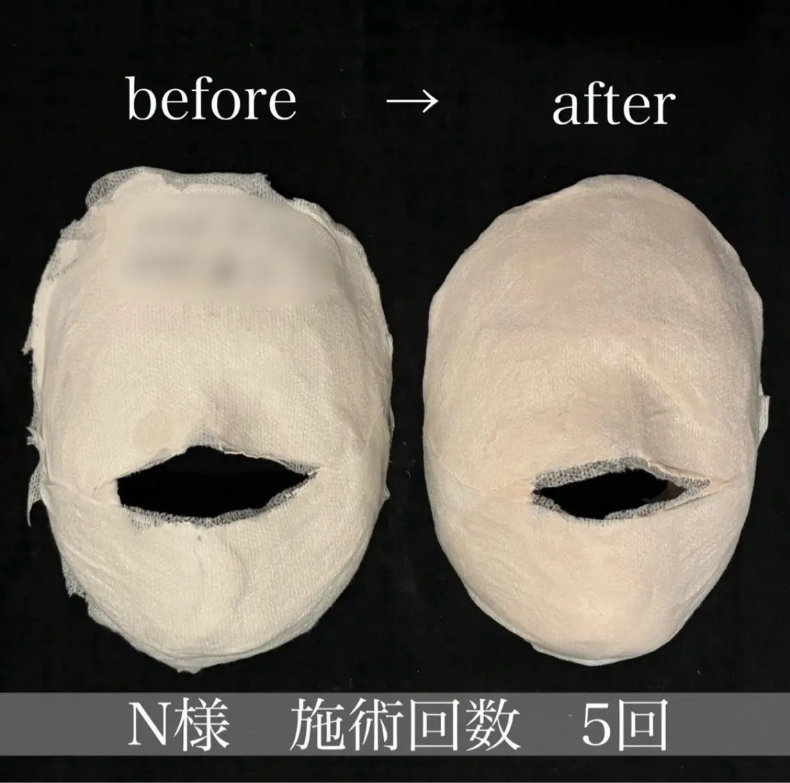 小顔人気No,3 【立体小顔】小顔コルギ石膏パックxデコルテマッサージの写真