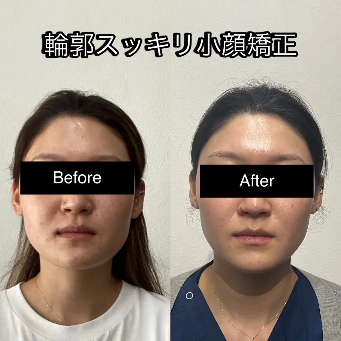 ミニモ限定！『鏡を見るたびに嫌になる輪郭を変えたい人へ』小顔整体の写真