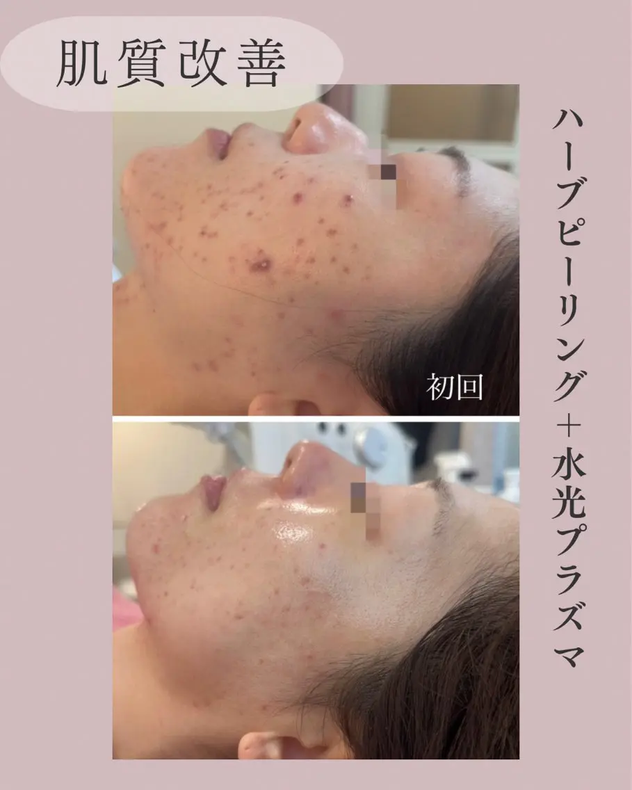エステ 小顔＆肌質改善 NICORIのエステ・リラクイメージ