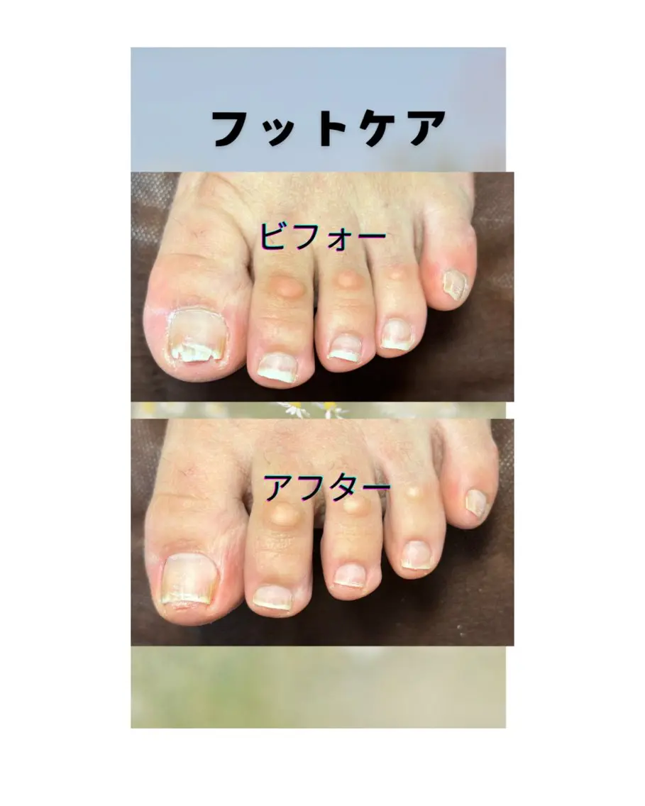 フットケアの写真