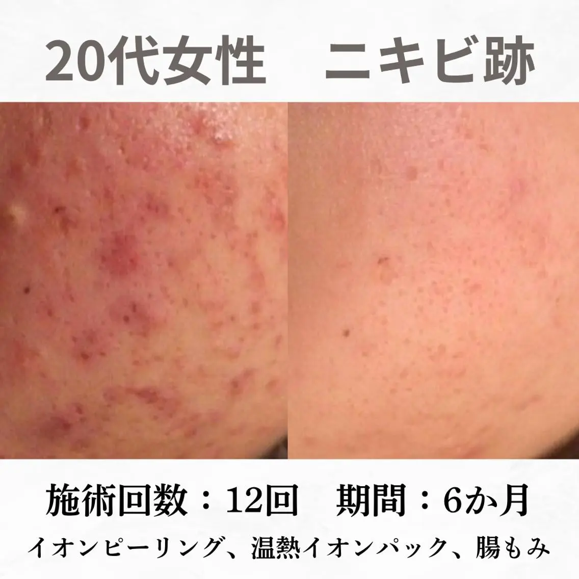 重度ニキビ専門🌼 ダウンタイムなしのエステ・リラクイメージ
