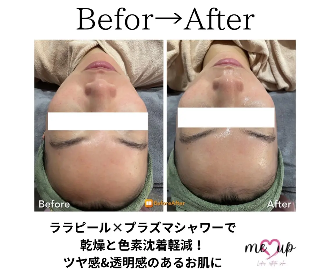 エステ Meupニキビ専門店 背中/ハーブ/肌管理のその他イメージ