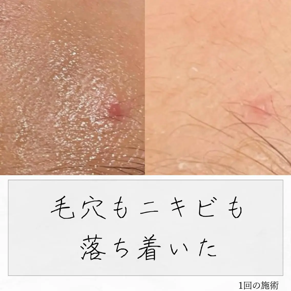 ニキビ経験者が施術 する専門サロン🌻のエステ・リラクイメージ