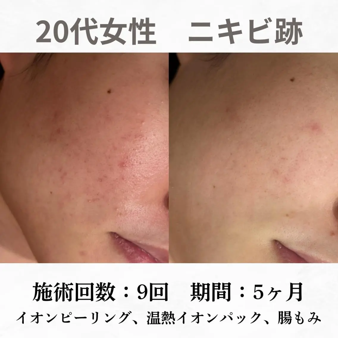 重度ニキビ専門🌼 ダウンタイムなしのエステ・リラクイメージ