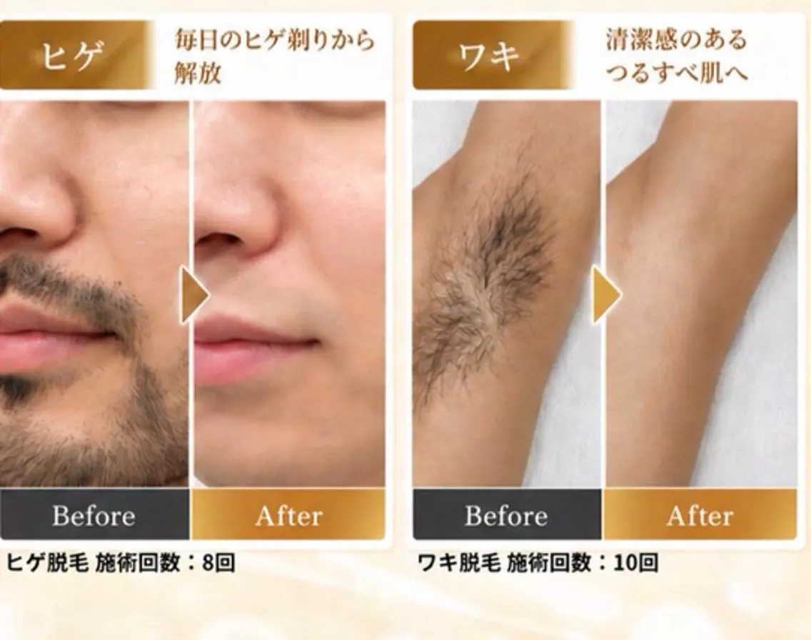 【メンズ脱毛】men'sヒゲ脱毛の写真
