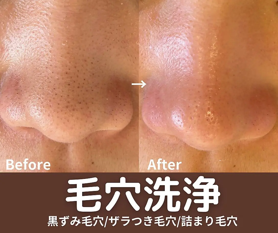 ツルツル毛穴ケア　黒ずみくすみ撃退　マッサージ付きの写真