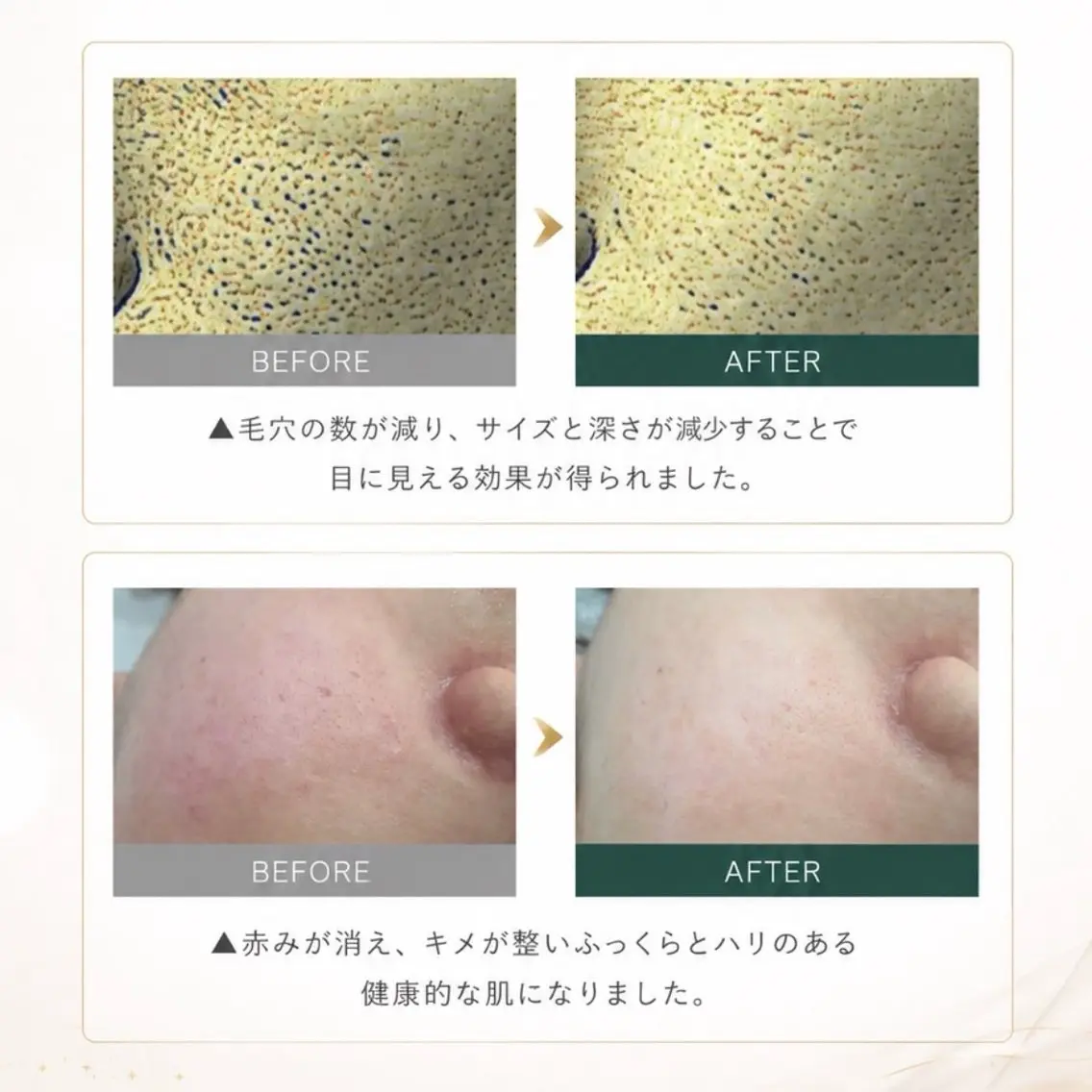 【韓国肌プログラム】肌を育てる次世代トリートメント◇メソプロプラスの写真