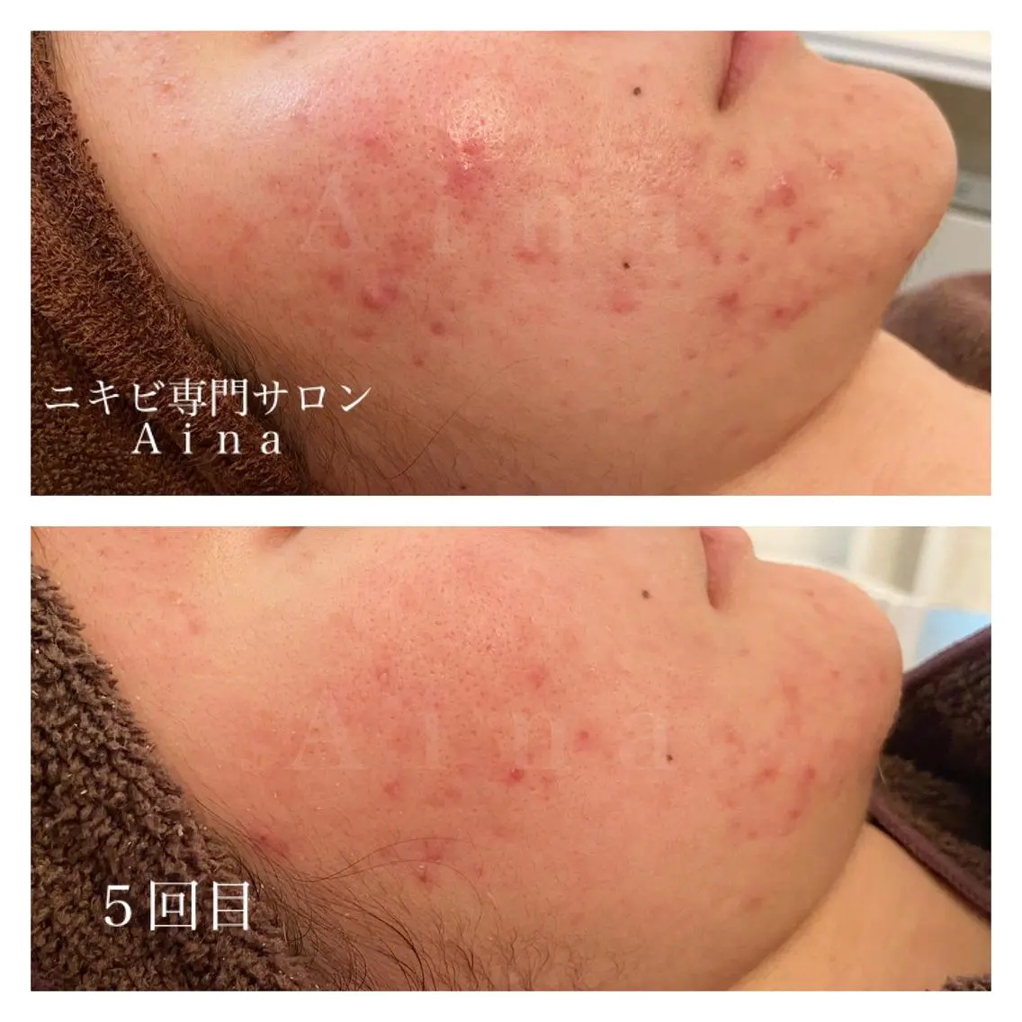 セミロング カラー パーマ ヘアアレンジ メンズ キッズ ネイル マツエク・マツパ ニキビ跡専門サロン Ａｉｎａのエステ・リラクイメージ