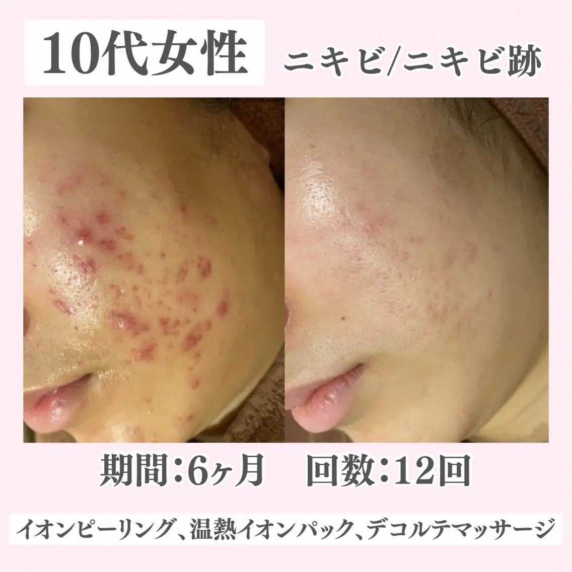 エステ リラク ニキビ・肌質改善専門 ♡人生が変わるサロンのエステ・リラクイメージ