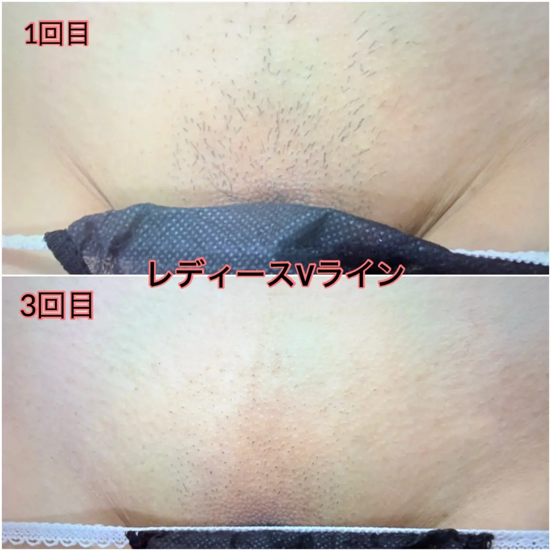 キッズ 脱毛 NR Nara yukiのエステ・リラクイメージ