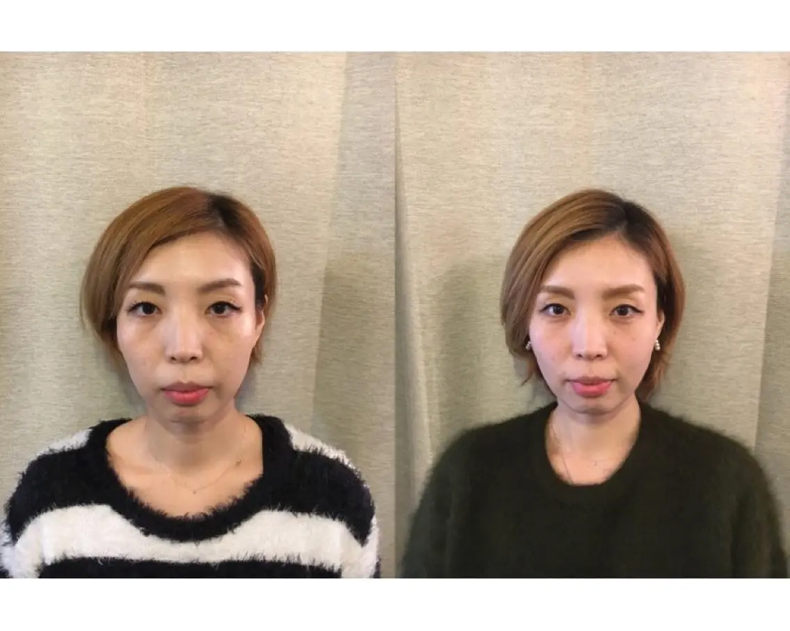 【✨人気No.1✨】美容鍼(プレミアムコース)*ご新規様限定*🉐初回カウンセリング料無料の写真