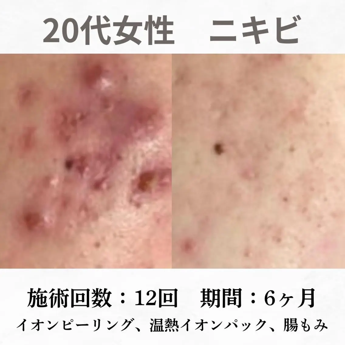 重度ニキビ専門🌷 ダウンタイムなしのエステ・リラクイメージ