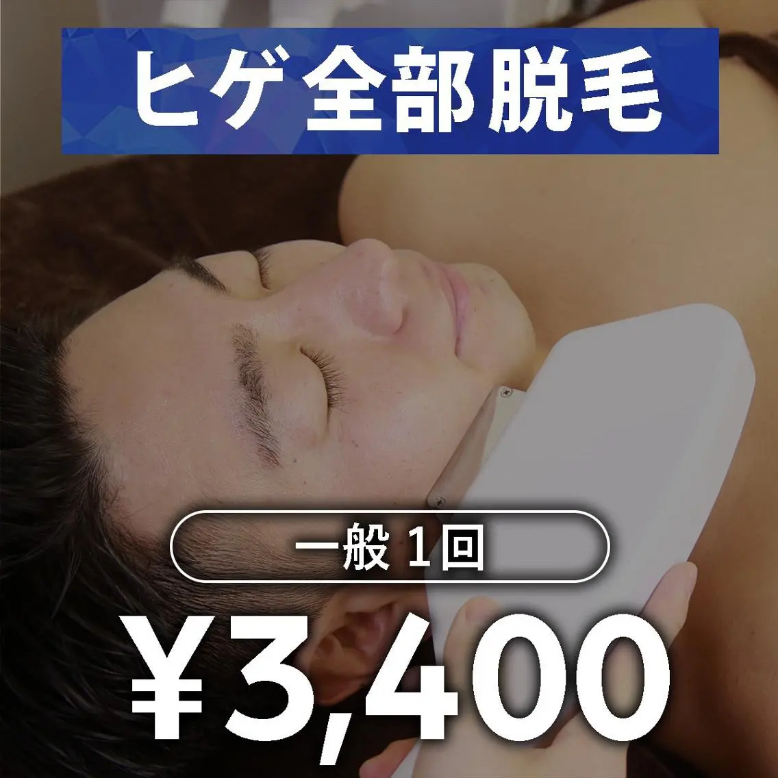 【メンズ脱毛】ヒゲ脱毛 1回の写真