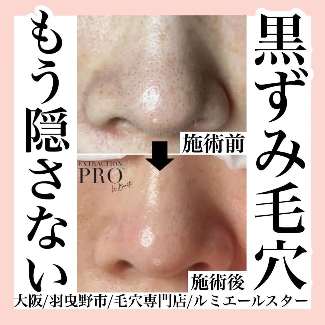 エステ 最速 毛穴シミ改善 いくえのその他イメージ