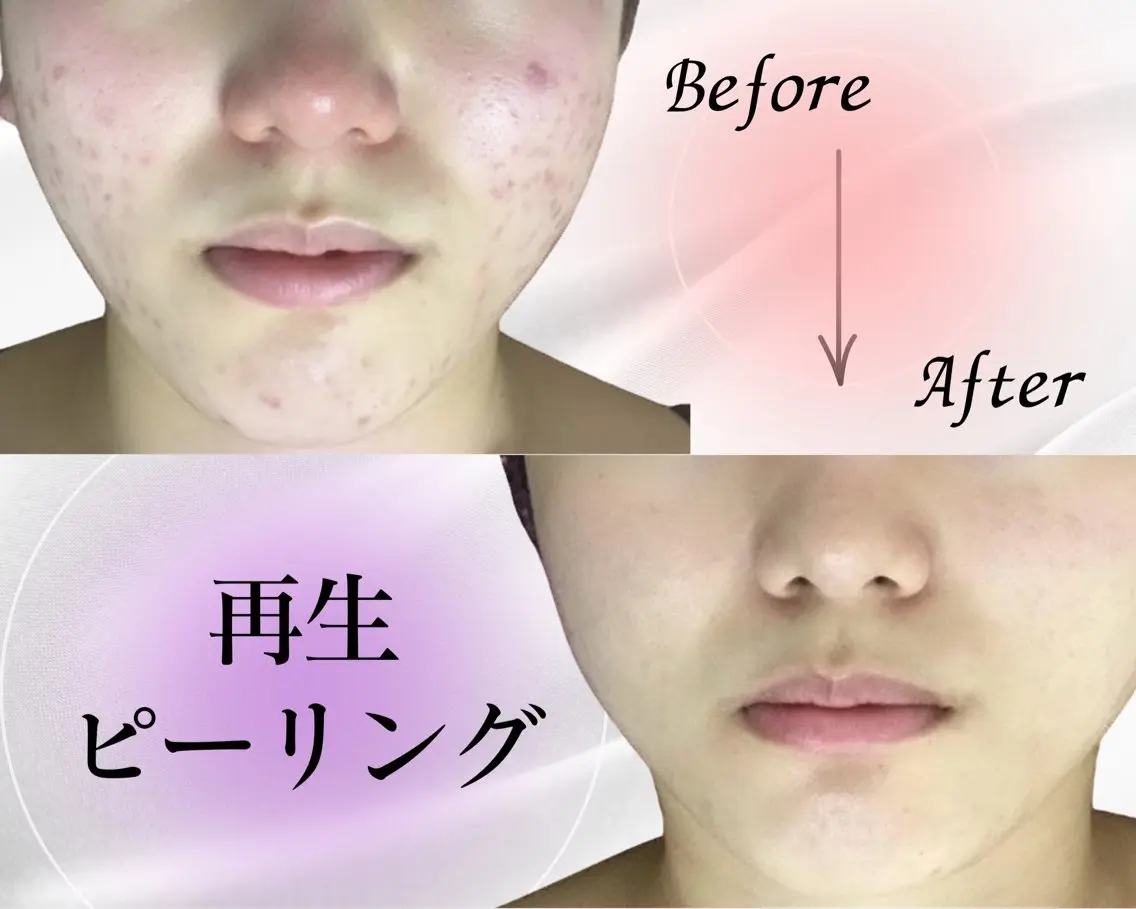 【毛穴最強ケア】肌育ピーリング/黒ずみ/乾燥/ざらつき/開き/ニキビ/剥けないの写真