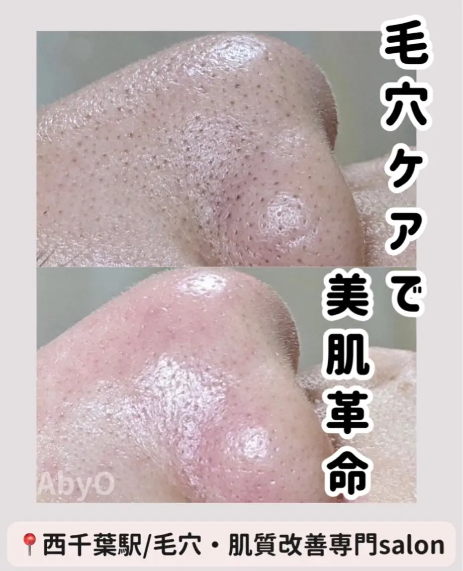 メラニン毛穴ケアコース　【5月まで新生活応援📣キャンペーン中】の写真
