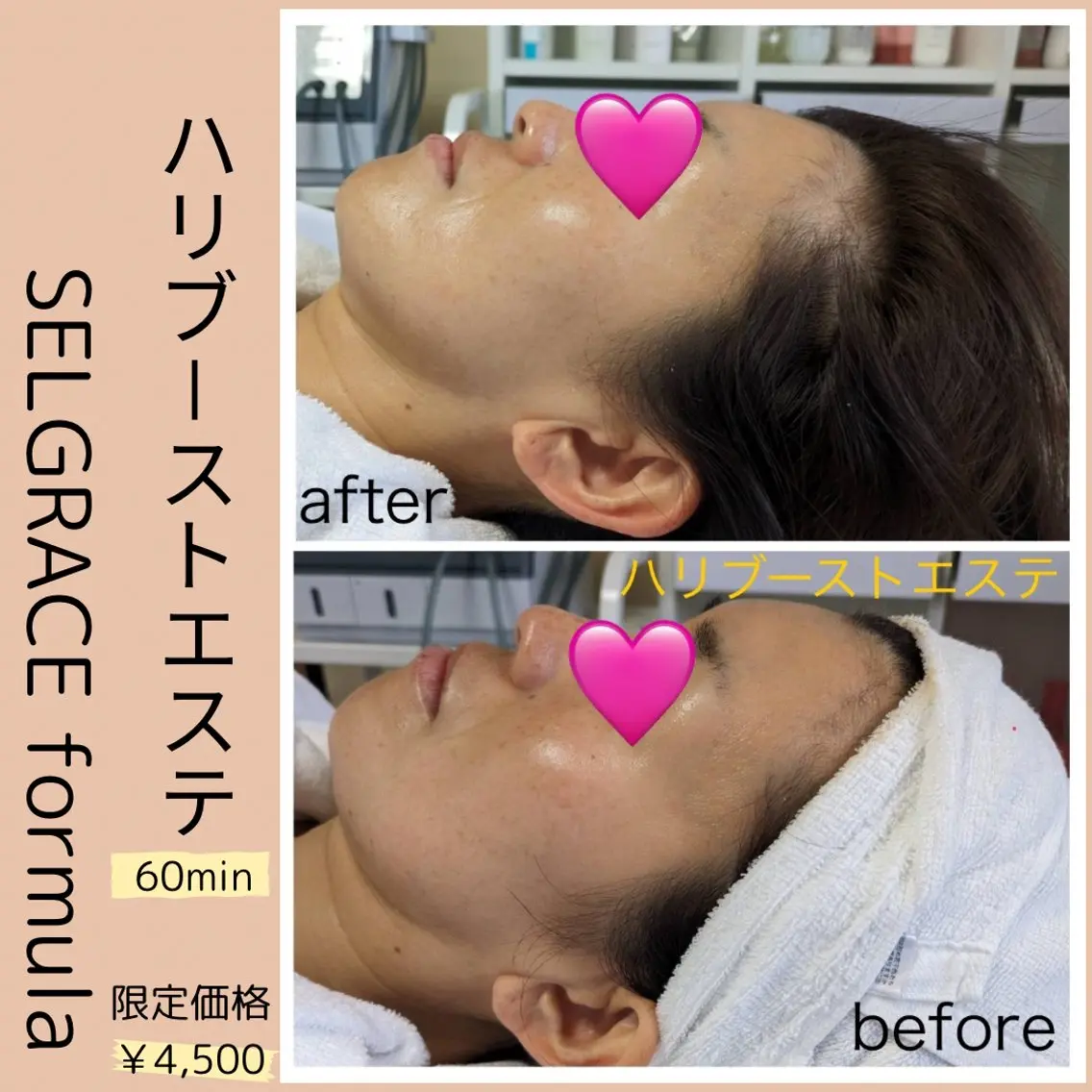 🧡ハリブーストエステ🧡EMSでハリUPエイジングケアの写真