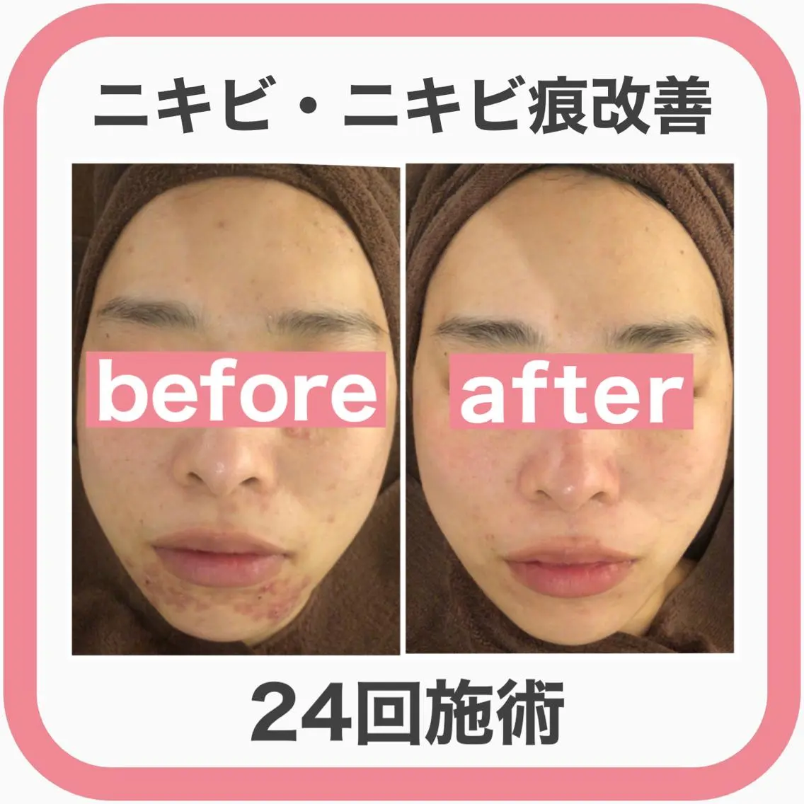 ミディアム カラー パーマ ヘアアレンジ メンズ キッズ ネイル マツエク・マツパ エステ リラク ニキビ・肌質改善専門 ♡人生が変わるサロンのエステ・リラクイメージ