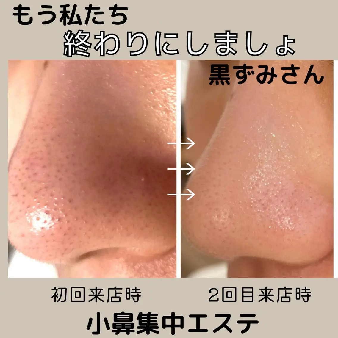 ✨得々2回コース✨現金払い限定💰毛穴が気になる方におすすめ♡小鼻すっきりエステの写真