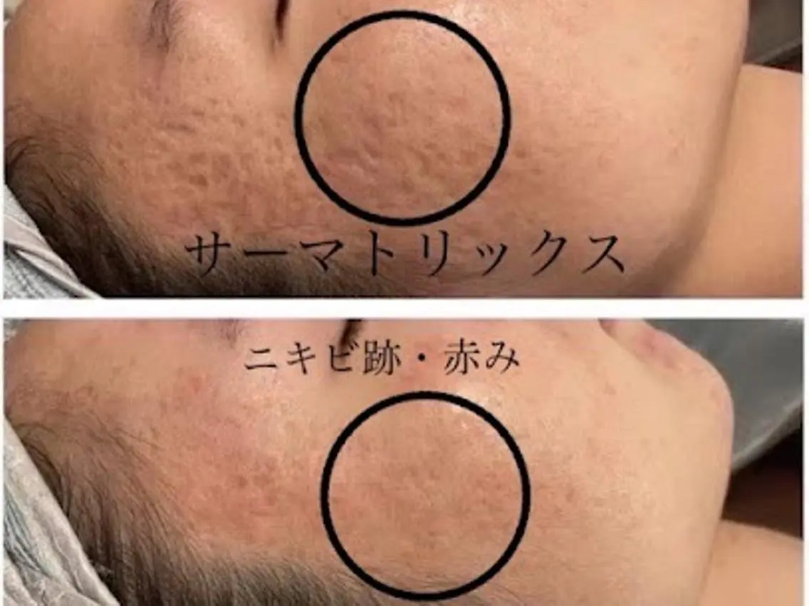 凸凹頬徹底ケアコース【頬のニキビ凸凹クレーター跡をしっかりケア】　5500円（６０５０）の写真