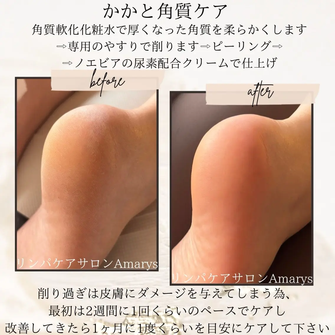 🦶かかと角質ケアの写真