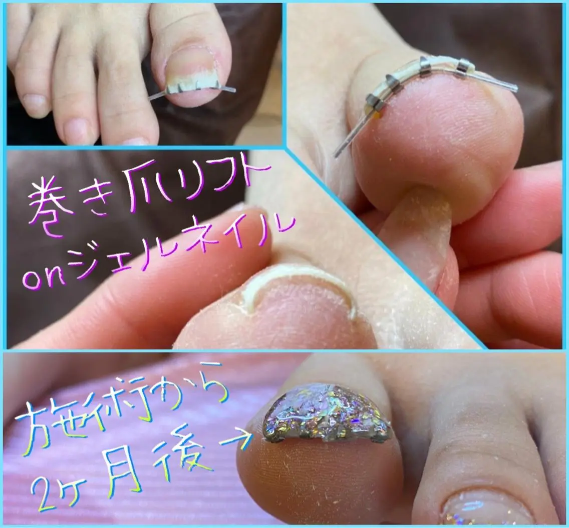 ネイル フットネイル グラデーション ラメ(グリッター) ラメグラデーション 持ち込み ♢ME2ROOM♢ #巻き爪#リラクのネイルデザイン