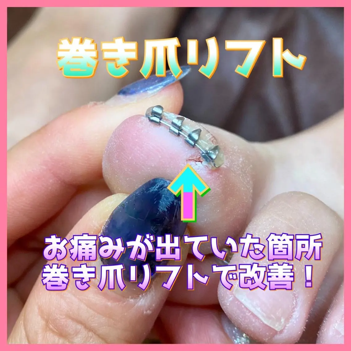 ネイル ジェルネイル ♢ME2ROOM♢ #巻き爪#リラクのネイルデザイン