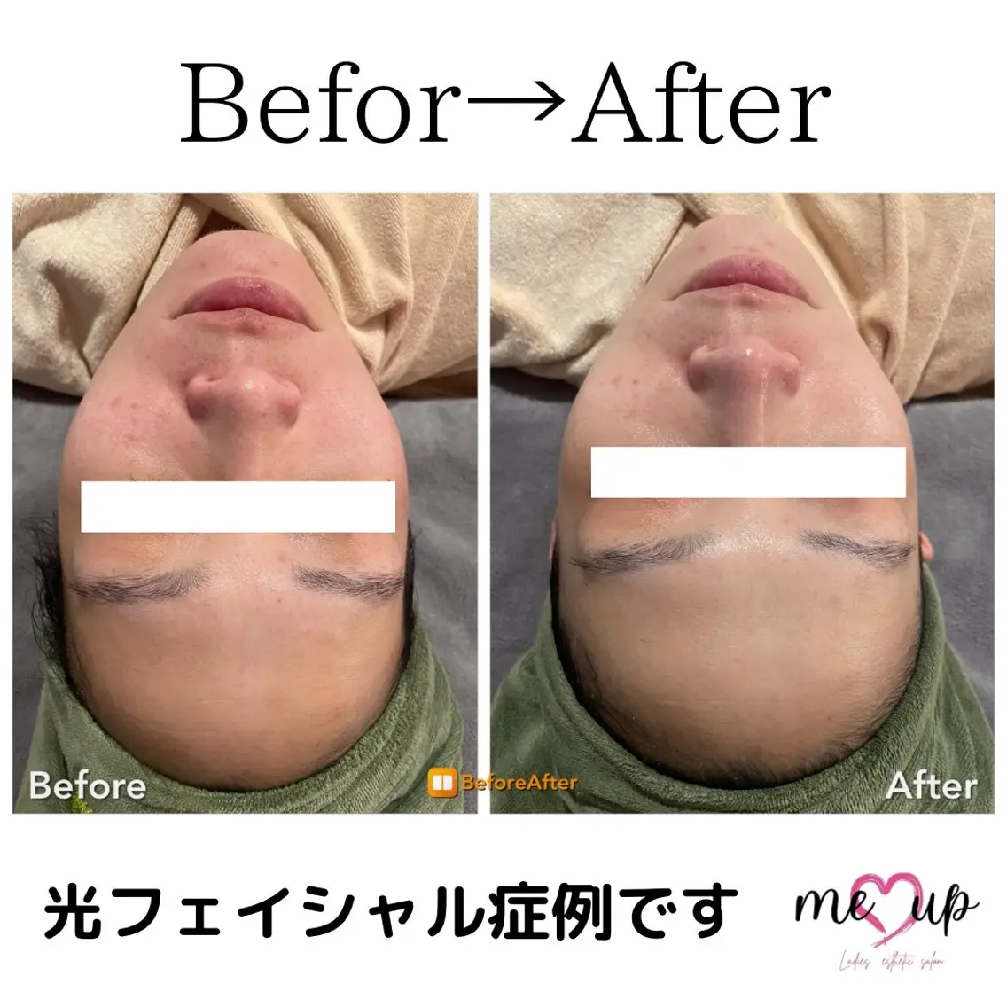 エステ Meupニキビ専門店 背中/ハーブ/肌管理のその他イメージ