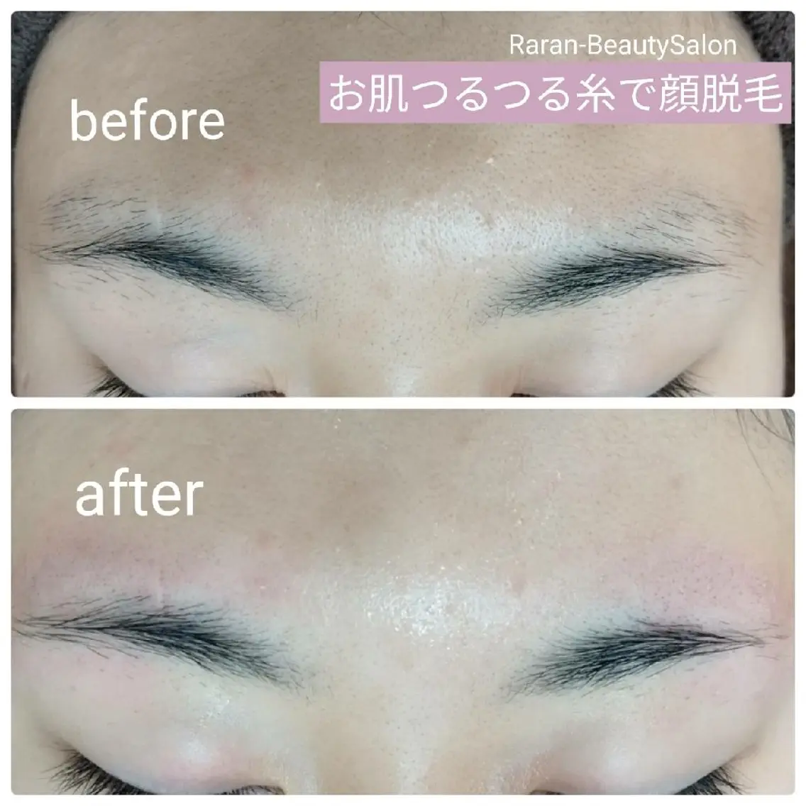 【お肌つるつる糸で顔脱毛* フェイスコース】うぶ毛✨ひげ✨ボサボサ眉毛✨化粧ノリアップ‼️の写真