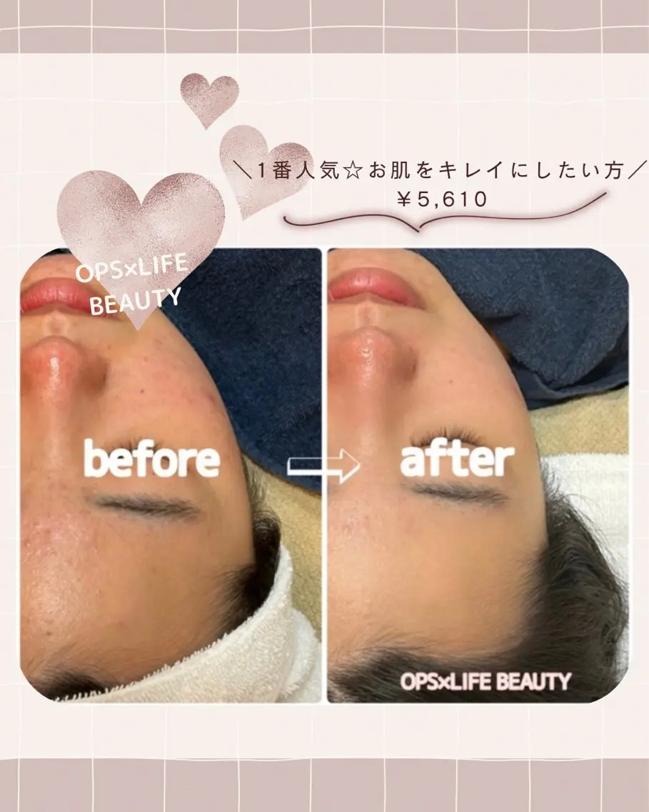 【1番人気☆お肌をキレイにしたい方】剥離なしピーリング30分コース¥5,610の写真