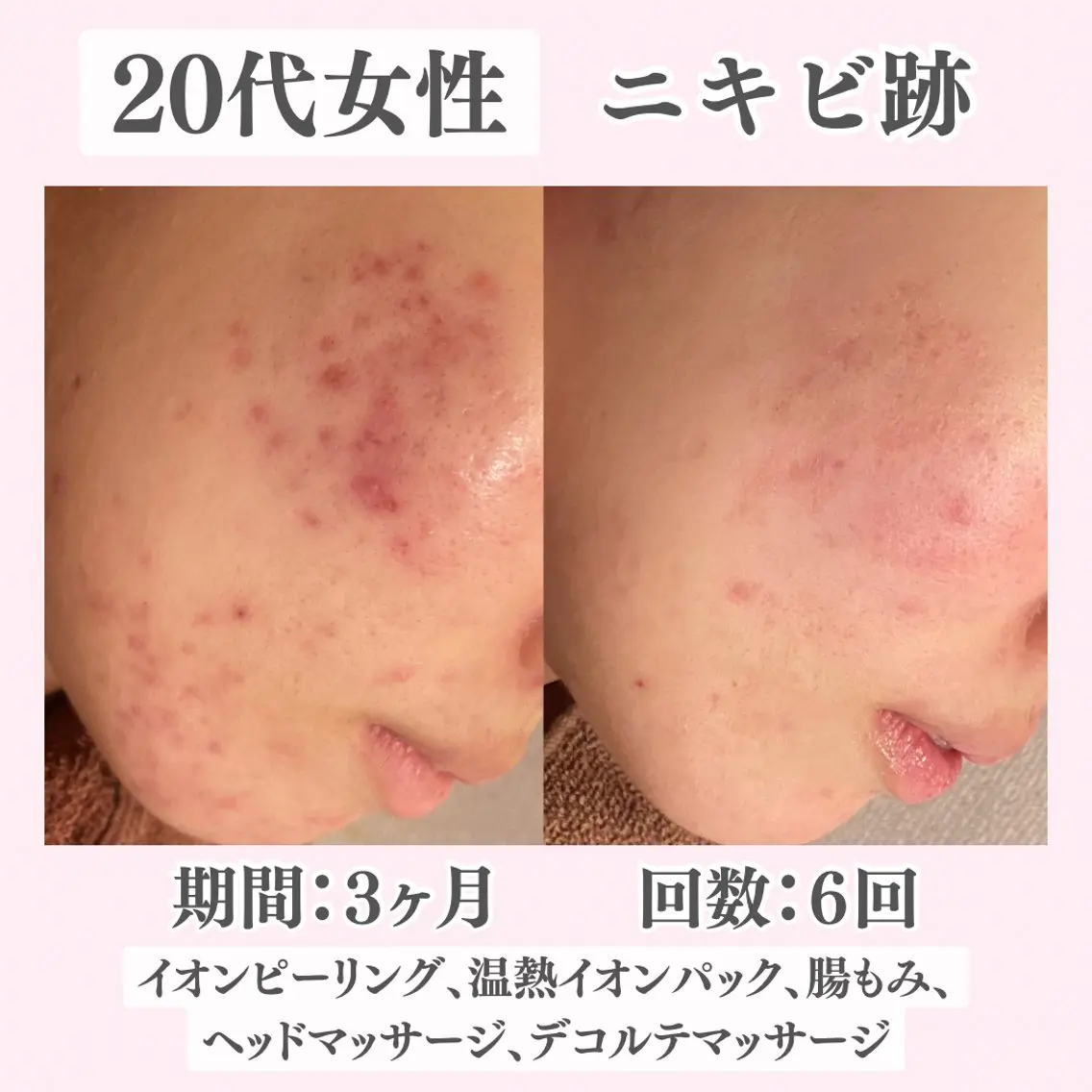 エステ リラク ニキビ・肌質改善専門 ♡人生が変わるサロンのエステ・リラクイメージ