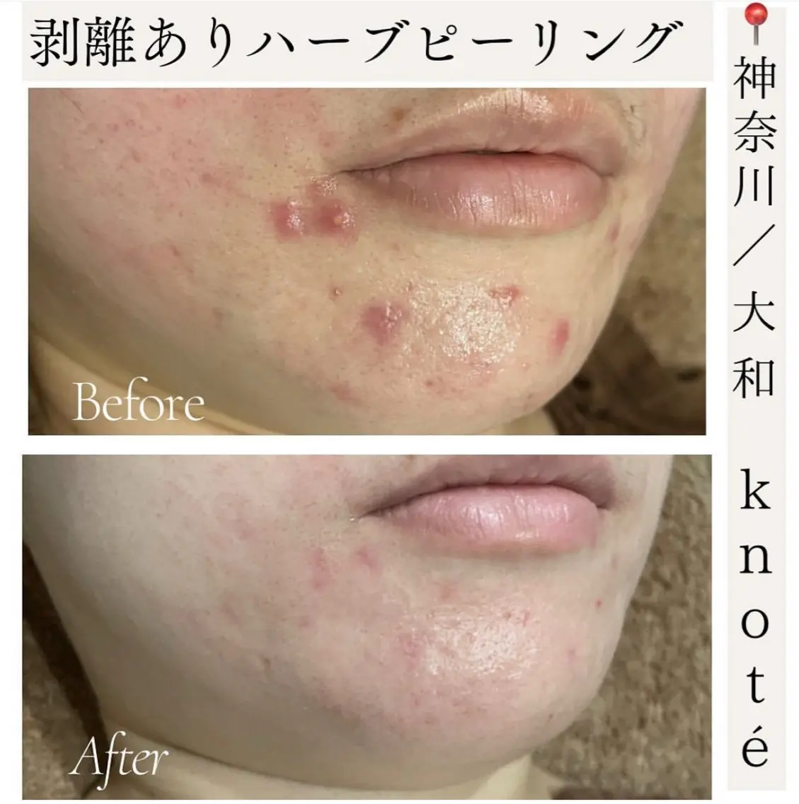 美容サロンカタログカタログ「剥離ありハーブピーリング 1回目の施術3