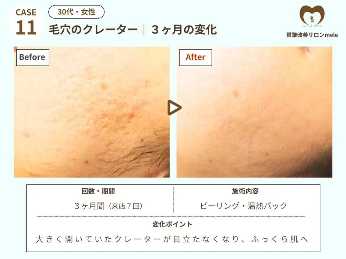 エステ リラク ニキビケア・毛穴専門 mele|もりぞののエステ・リラクイメージ