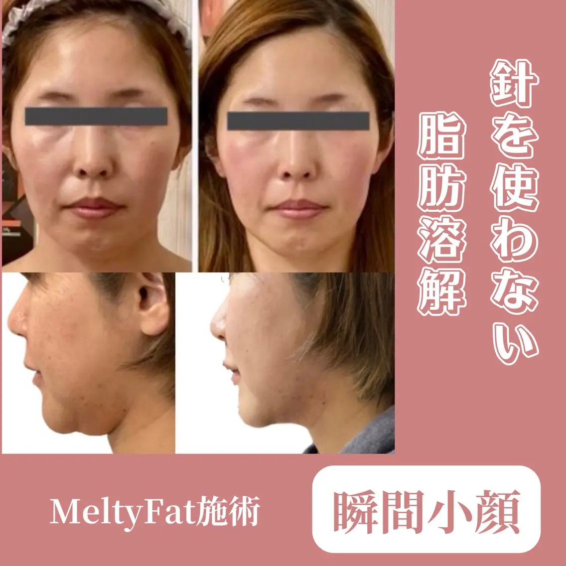 【瞬間小顔】鍼の使用なしで脂肪をケア&ハイパーナイフ小顔&筋膜マッサージ90分★美白パック付の写真