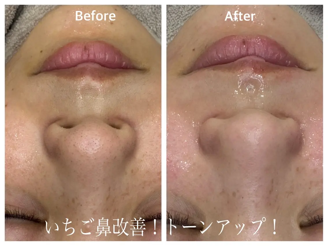 🟡毛穴に更に特化したセットメニュー【マツヤニパック✖️毛穴侍】※パッチテスト済みの方の写真