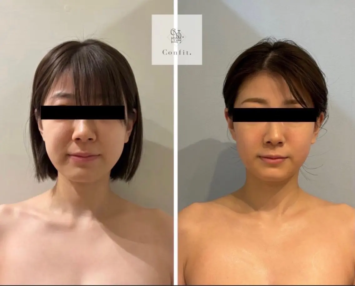 💠小顔人気No,2【小顔造顔】針を使わない【脂肪コントロール剤】導入 5ml×小顔リンパマッサージの写真