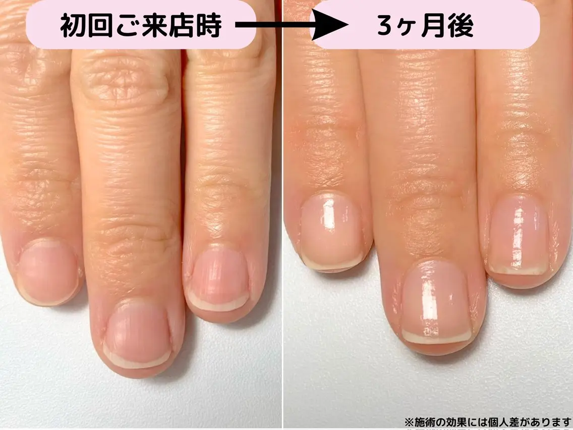 自爪育成《最強のネイルケア3ヶ月コース》育成ケア8回分/育成専用ホームケアセット込の写真