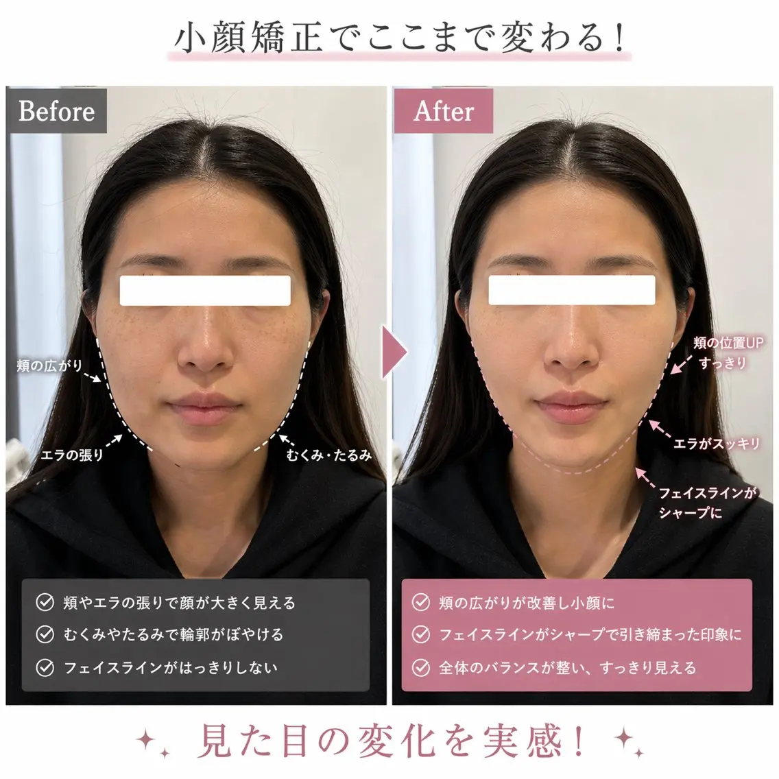 四角からVライン小顔!🦊【エラ張り食いしばり】小顔矯正+エラほぐし/エラが気になる方へ/初回限定3,300円の写真