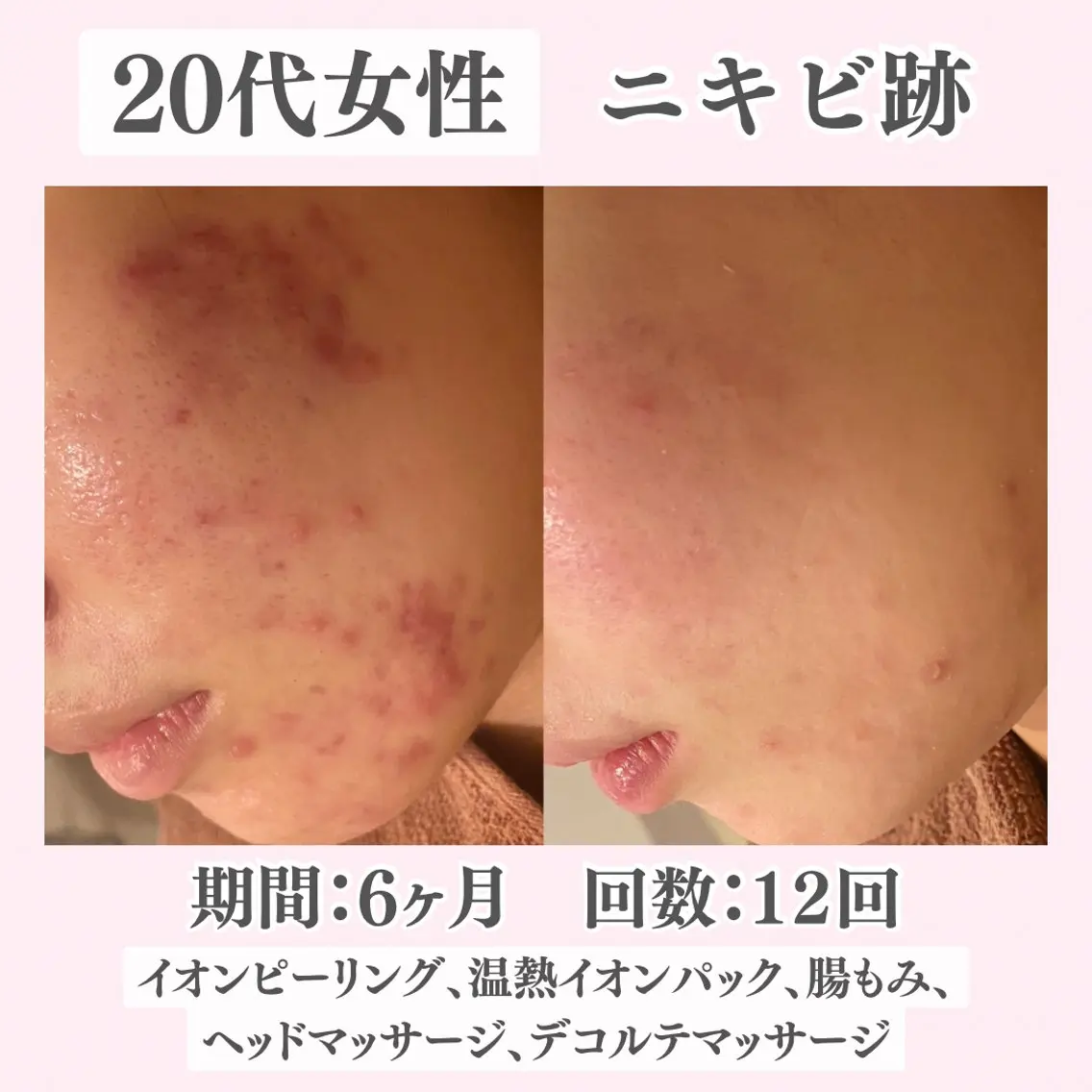 エステ リラク ニキビ・肌質改善専門 ♡人生が変わるサロンのエステ・リラクイメージ