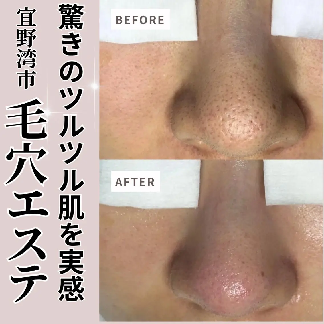 毛穴お悩みの方！透明感UP毛穴改善コース（毛穴エクストラクション、艶肌パック、ヘッドマッサージ付）の写真